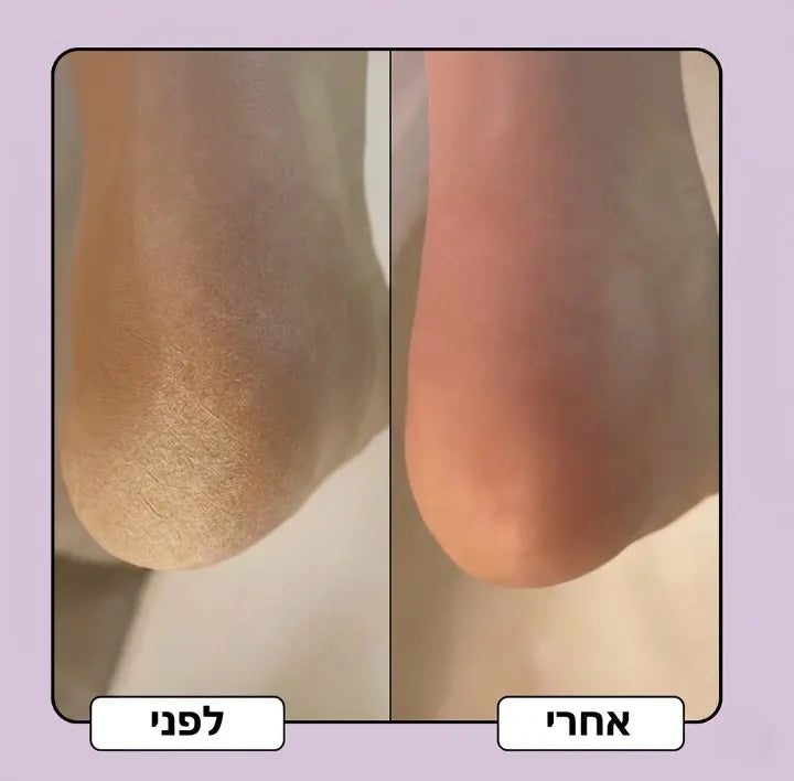 לפני ואחרי — אצבע רגל חלקה