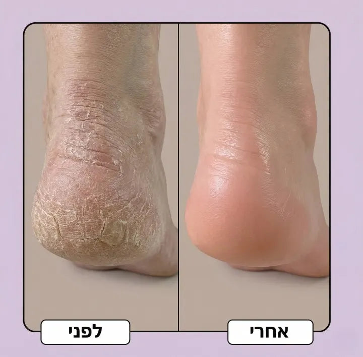 לפני ואחרי — עקב רך וחלק
